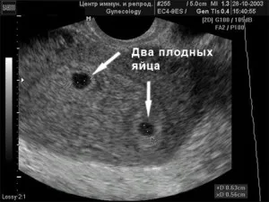 перші ознаки вагітності узі