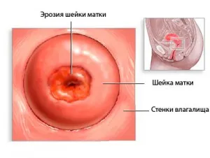ерозія шийки матки після вагітності