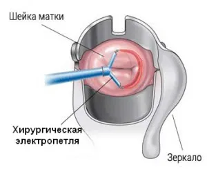 ерозія шийки матки після вагітності