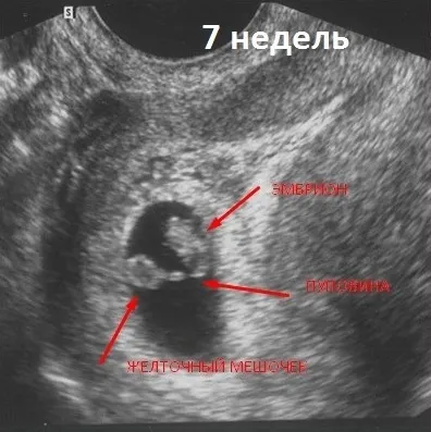 перші ознаки вагітності узі