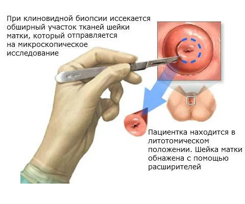 Біопсія шийки матки що таке біопсія шийки матки