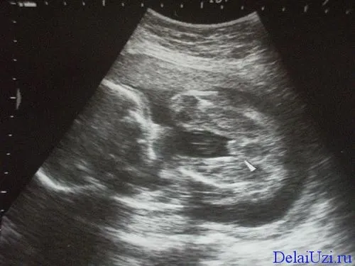 норма узі тиждень вагітність