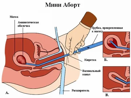 штучне переривання вагітності в ранні терміни