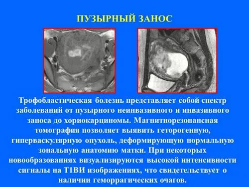 виділення при вагітності коричневого кольору