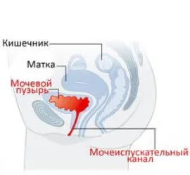 цистит при вагітності