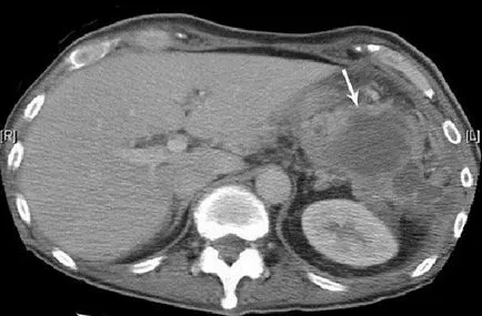 абсцес subdiaphragmatic