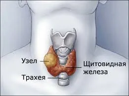 Заболявания на щитовидната жлеза и симптоми