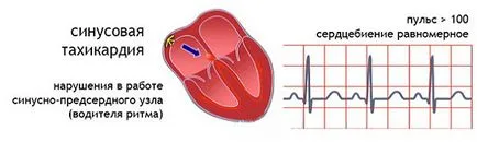 Arrhythmia tünetek és a kezelés