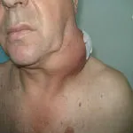 водянисті виділення у вагітних