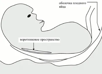 скринінг 1 триместру вагітності