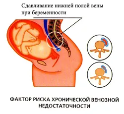 варикоз при вагітності