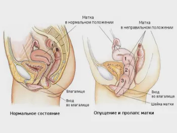 як змінюється піхву під час вагітності