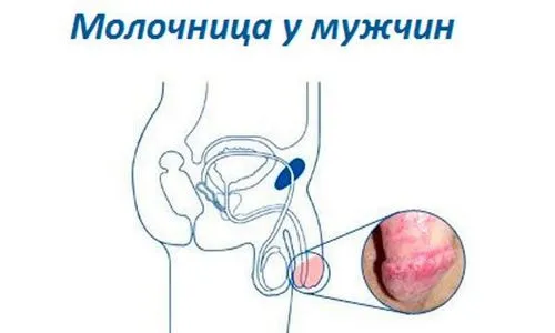 хронічна молочниця і вагітність