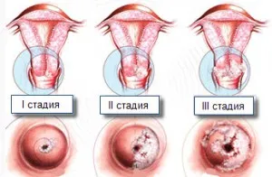 біопсія шийки матки під час вагітності