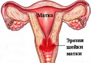 біопсія шийки матки під час вагітності