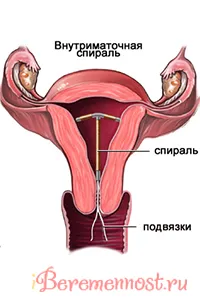 Спіраль від вагітності спіралі від вагітності