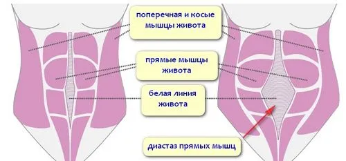 кесарів розтин і спорт