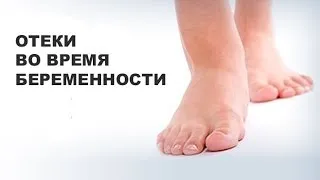 набряки ніг під час вагітності