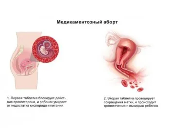 До якого терміну можна робити аборт? медикаментозний до якої термін можна робити аборт вагітність міні вакуумний таблетка таблетований