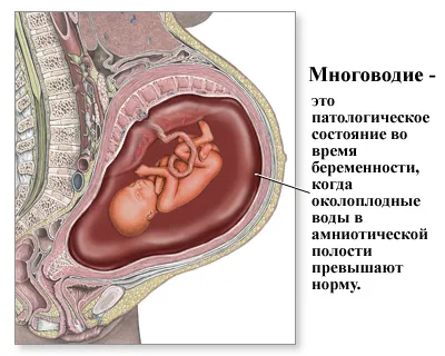 чим небезпечне многоводие у вагітних