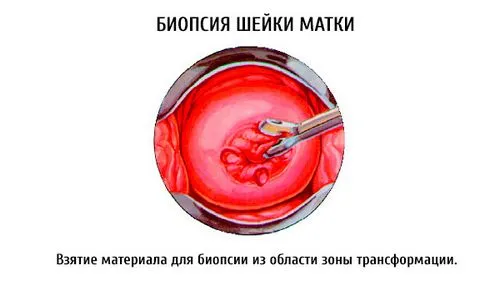 біопсія в гінекології