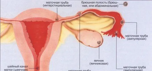 чому відбувається позаматкова вагітність