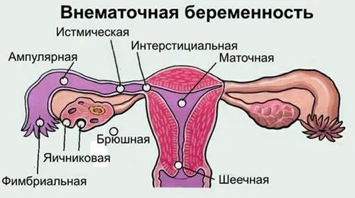 позаматкова вагітність після аборту