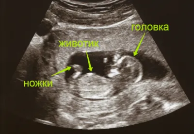 вагітність 12 тижнів