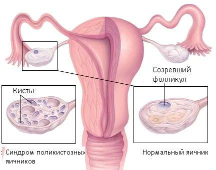 полікістоз яєчників