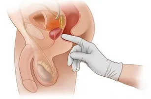 В секреті простати чоловіків staphylococcus haemolyticus гемолітичний стафілокок у вагітних
