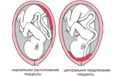 коричневі виділення при вагітності