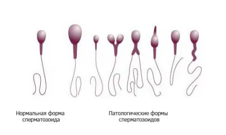 що завмерла вагітність