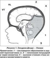 Walker sindromul dandy (anomalie, malformație) Cauze, simptome, tratament