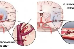 Simptomele circulației cerebrale