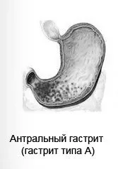 як лікувати фолікулярний гастрит