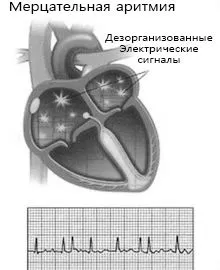 аритмія