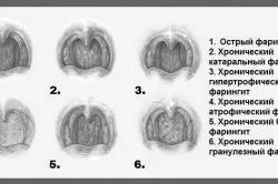 Атрофічний фарингіт: причини, симптоми і лікування (фото і відео) симптоми
