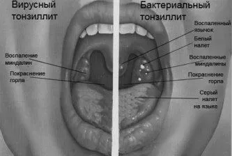 ангіна