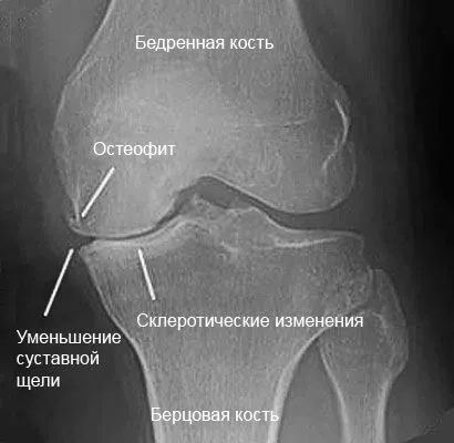 як лікувати артроз 2 ступеня