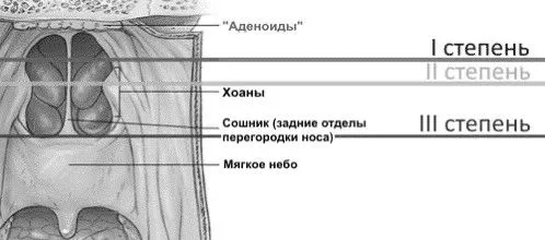 Аденоїди 2 ступеня у дітей: симптоми, діагностика та лікування фото аденоїди