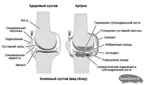 як лікувати артроз 2 ступеня