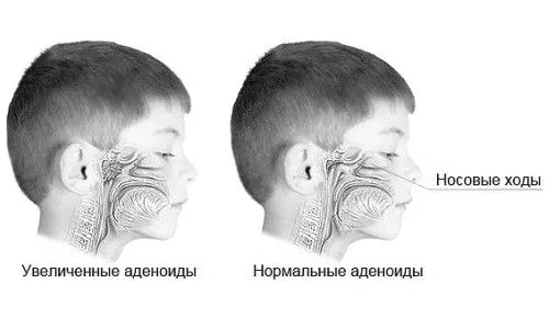 аденоїди