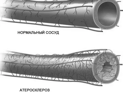 атеросклероз