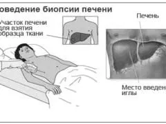 як лікувати цироз печінки останньої стадії