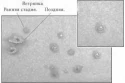 Чим мазати вітрянку крім зеленки лікувати вітрянку без зеленки