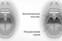 як лікувати фарингіт мамі