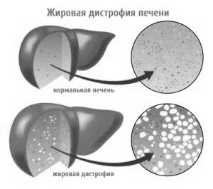 цироз
