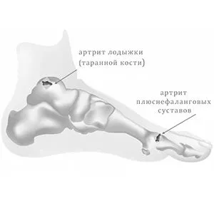 Болять суглоби стопи біль в суглобі великого пальця ноги