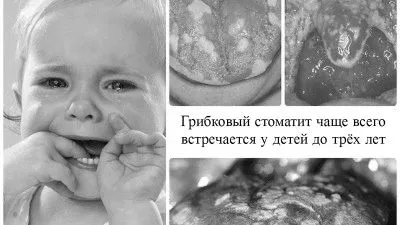 як лікувати стоматит у дитини 3 років