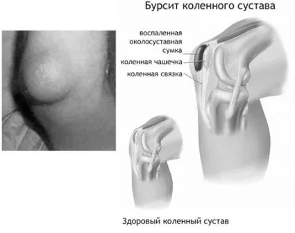 суглоба